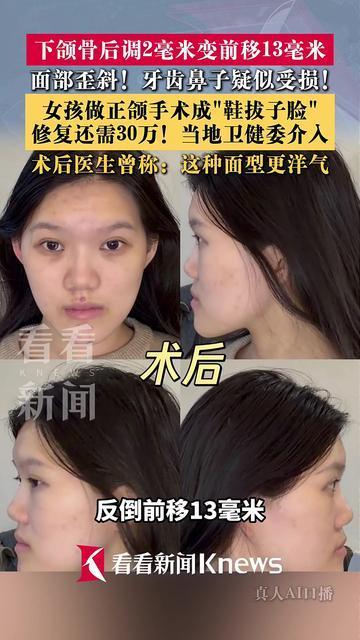 女孩做正颌手术成"鞋拔子脸" 当地卫健委介入