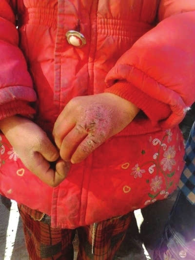 山区小孩冬天冻手图片图片