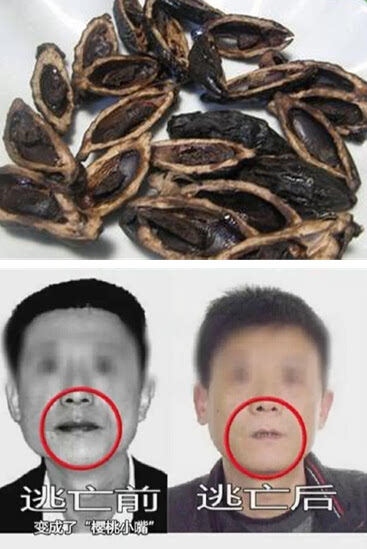 槟榔癌变切嘴的图片图片