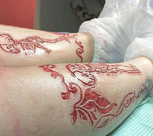 泰国刺青尸油感染图片