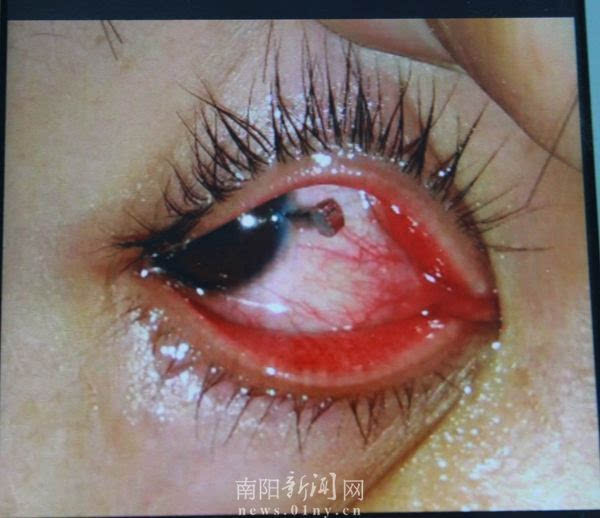 南阳市眼科医院光明通道抢救15岁眼睛重伤少年