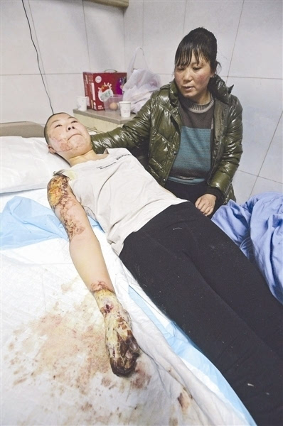 李燕3度烧伤,目前急需做植皮手术 摄影记者 王天志