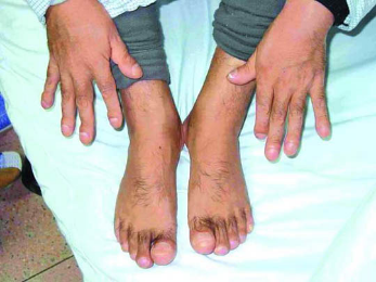 肺癌早期脚趾变化图片图片