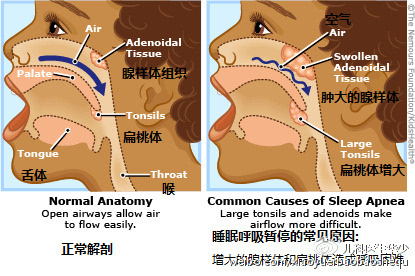 打鼾结构图片