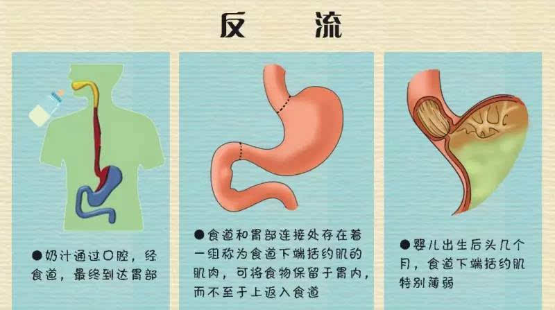 婴幼儿胃部开口处-食道下端括约肌和贲门较松,当腹压增高时,已进入