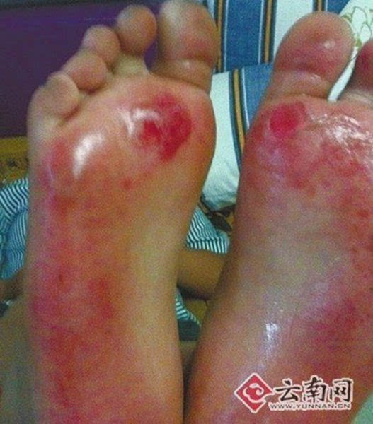 孩子脚底的血泡(该图来自受伤孩子亲戚网文)不合要求脱鞋跑圈22日下午