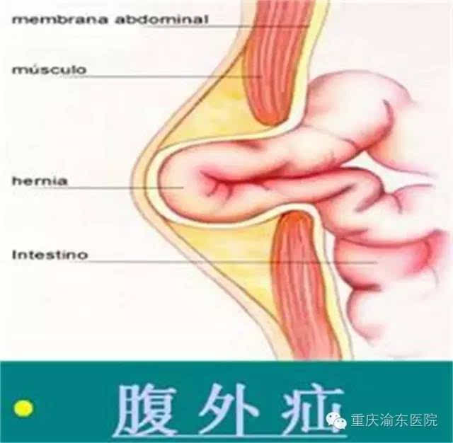 奉節縣首例腹腔鏡疝修補手術在渝東醫院成功開展