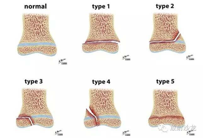 图文并茂:儿童青少年常见运动损伤和治疗(骨折篇)