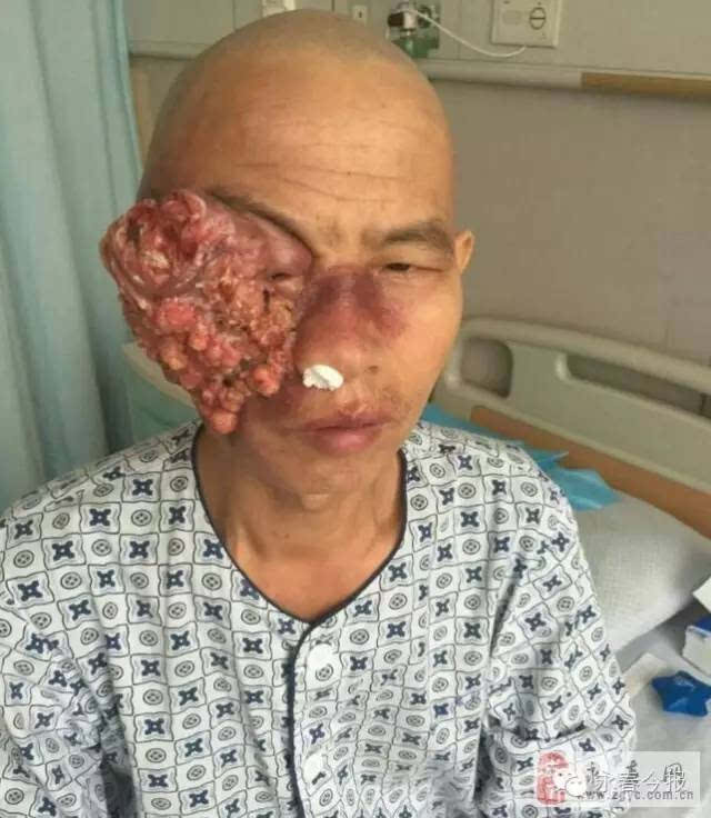脸上恶性肿瘤早期图片图片