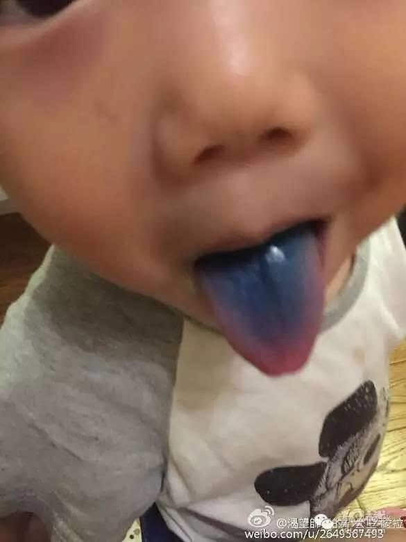 2岁男孩舌头变蓝粑粑也变蓝都是这个害的