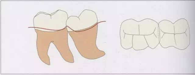 智齿嵌入被处理牙邻接面的倒凹,即便分离成功,成形范围也会变大