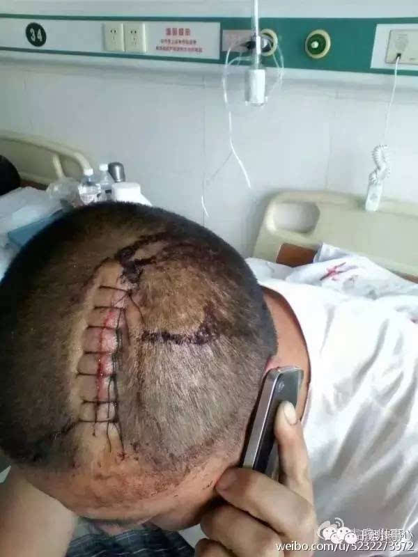 其中一男子头部受伤,头顶上密密麻麻缝了十多针