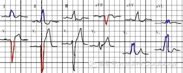 8可以看出左前分支对应i,avl导联,因此其心电图表现为i,avl导联呈qr型