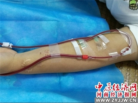 郑州市九院血液净化中心成功开展首例钝针穿刺新技术