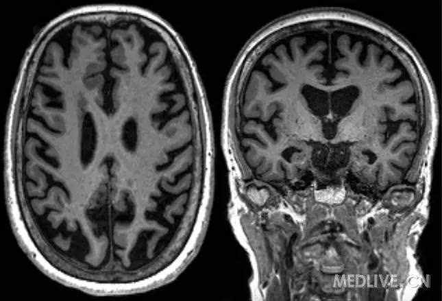 来挑战:5个病例,掌握阿尔茨海默病的诊断