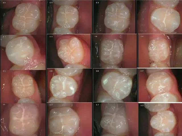 牙齿发育沟图片图片