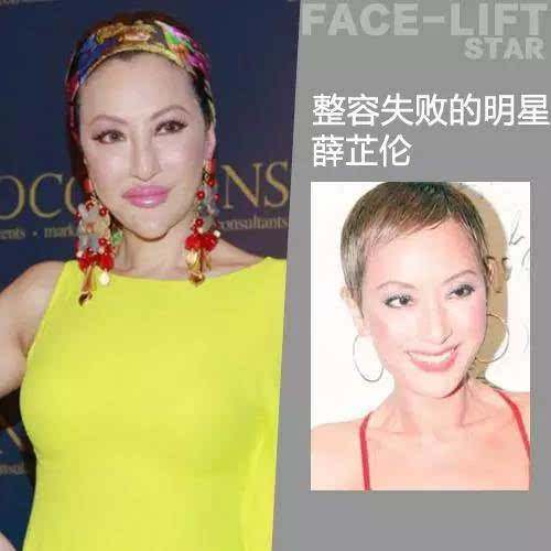 10個明星真實案例告訴你整容失敗什麼樣絕對亮瞎眼