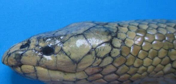 腹壁静脉曲张海蛇头图片