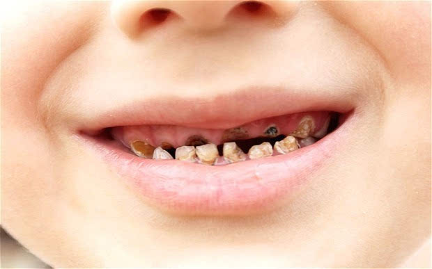 蛀牙是孩子最常见牙齿问题