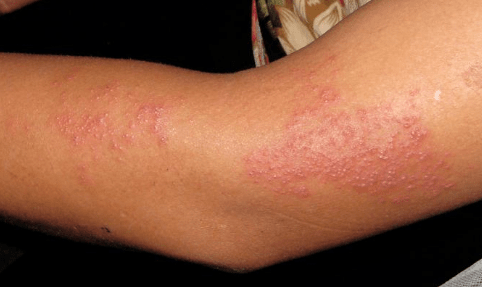 急性湿疹皮损初为多数密集的粟粒大小的丘疹,丘疱疹或小水疱,基底潮红