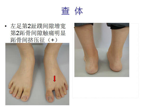 国际罕见病日系列谈足踝罕见病不可小觑