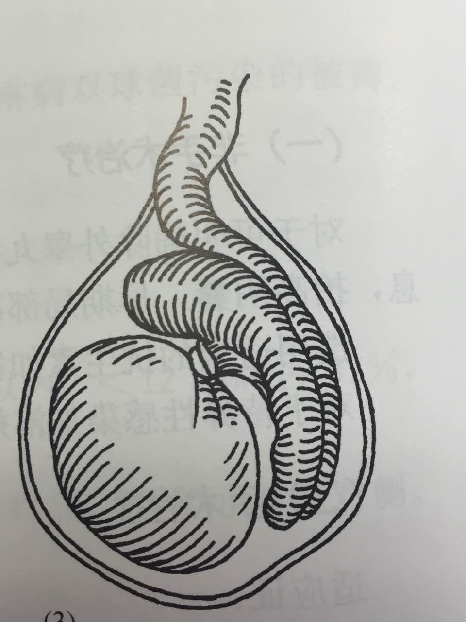 睪丸扭轉之 鞘內扭轉 發育青春前期