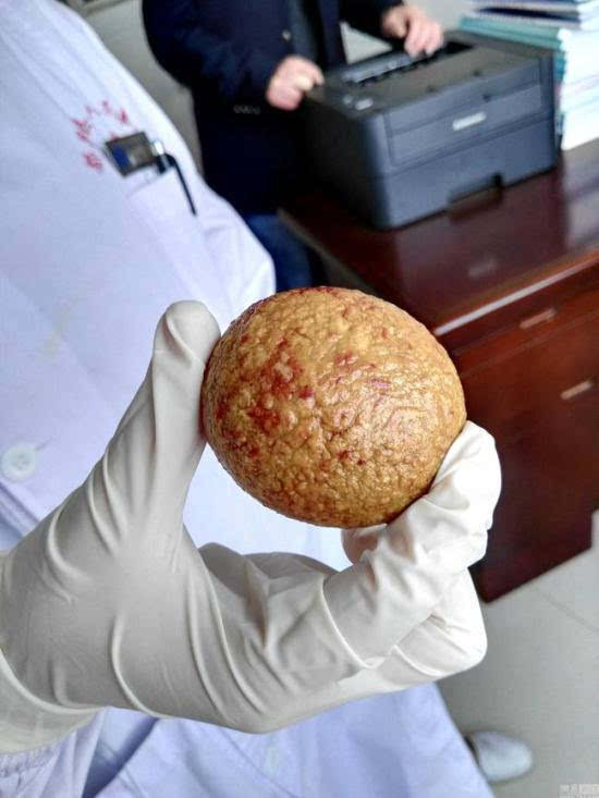 该膀胱结石直径约为6厘米,重达825克,结石呈圆形,从外观看起来像大