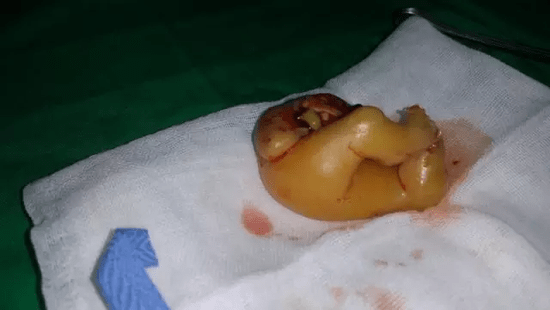 但是取出后发现,这并不是医学影像中的"肿瘤",而是"胎中胎",且重量