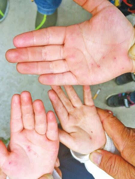 幼儿园女老师针扎20多名幼童 警方:已刑拘