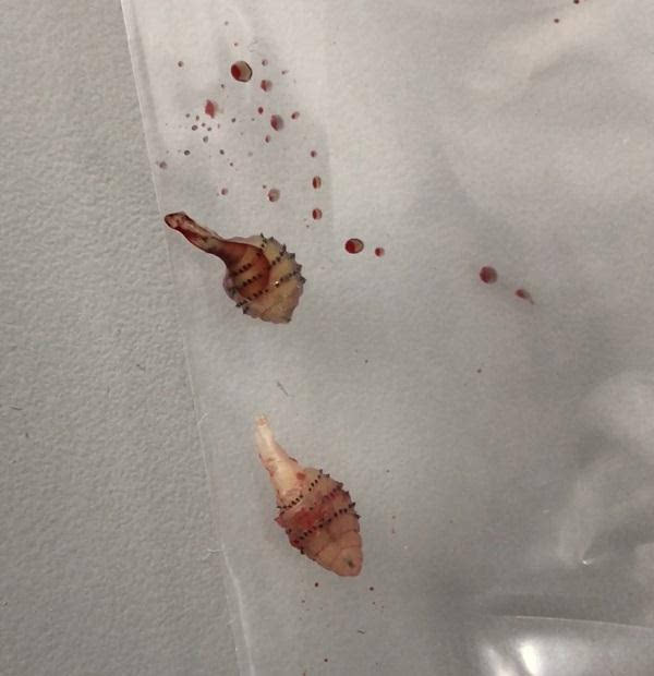 女子小腿取出活虫 竟然从溃破的皮肤拔出小虫的尸体