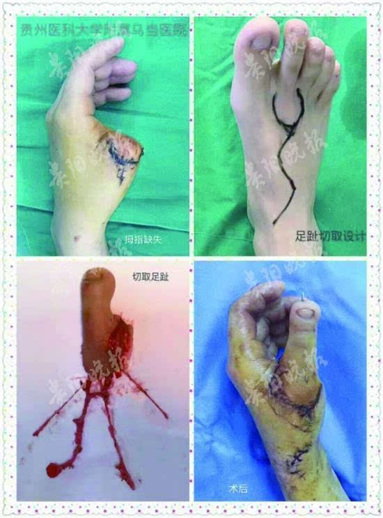 男子左手拇指被割断 医生移花接木脚趾变成手指