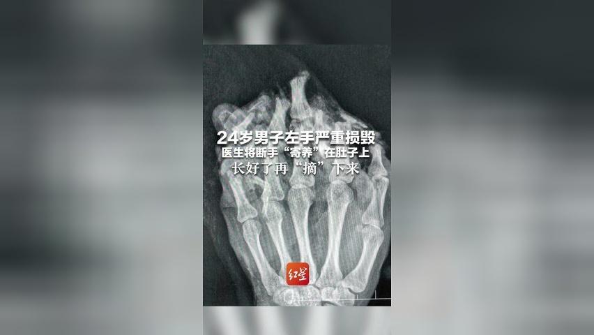 24岁男子左手严重损毁，医生将断手“寄养”在肚子上，长好了再“摘”下来，目前已完成分指手术进入康复期