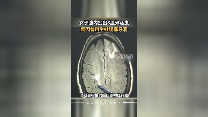 六旬老人脑内捉出8厘米活虫，疑因曾用生蛙腿塞牙洞，医生提醒
