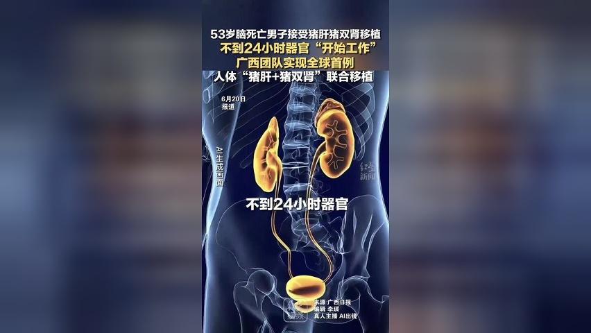 53岁脑死亡男子接受猪肝猪双肾移植 不到24小时器官“开始工作”广西团队实现全球首例 人体“猪肝+猪双肾”联合移植