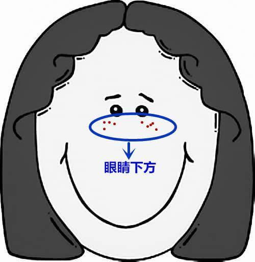 超全面面部痘痘分析图片文字马上收起来