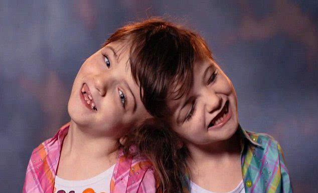 加拿大7岁连体姐妹共用大脑创造生命奇迹