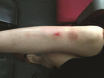 南京女子掉进站台缝隙 双腿膝盖以下多处擦伤图