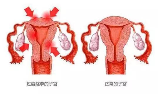 子宫平滑肌收缩图片
