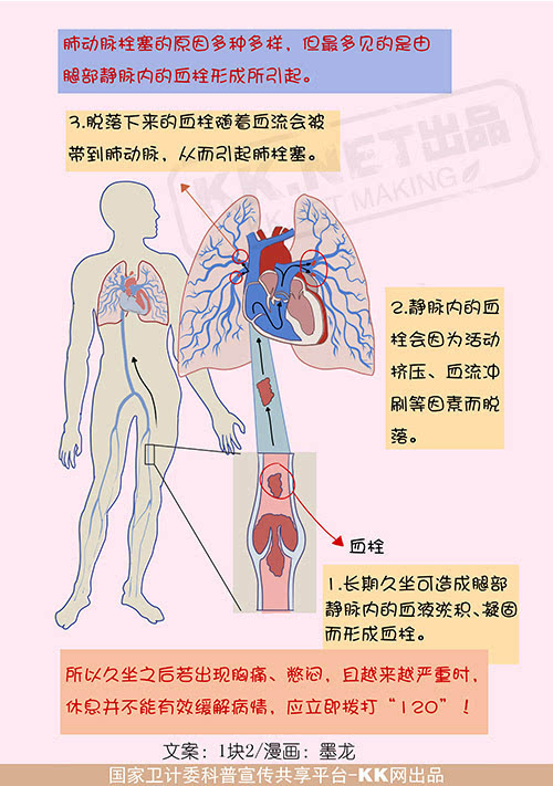 肺栓塞图片 示意图图片