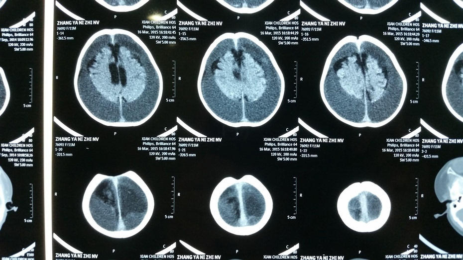 2014-11-11:頭顱ct:明顯腦萎縮,雙側幕上嚴重硬膜下積液,腦室擴張.