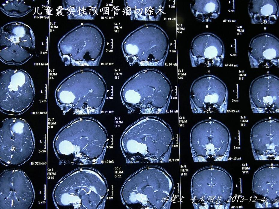 囊实性巨大钙化颅咽管瘤切除术